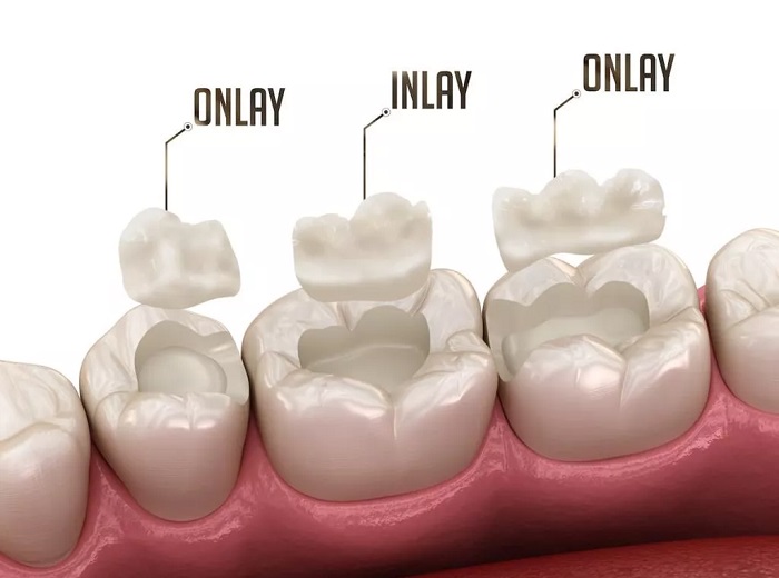 اینله و انله دندان مناسب چه افرادی است و چگونه نصب میشود