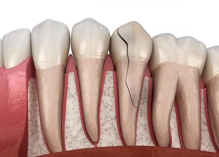 بیماری های دندان چه علائمی دارند
