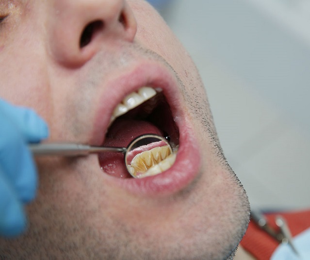 جرم و پلاک دندان چه عوارضی برای سلامت دندان ها دارد