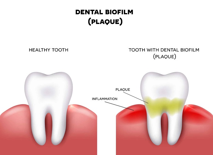 جرم و پلاک دندان چیست و چه معایبی دارد