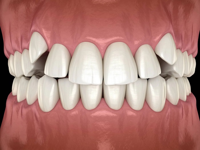 درمان شلوغی دندان ها چگونه انجام میشود