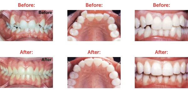 درمان شلوغی دندان ها و دلایل ایجاد آن