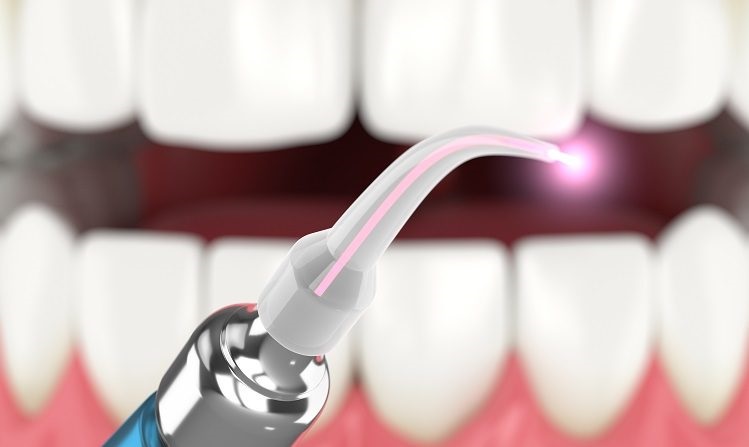 درمان پوسیدگی دندان با لیزر برای چه افرادی مناسب است