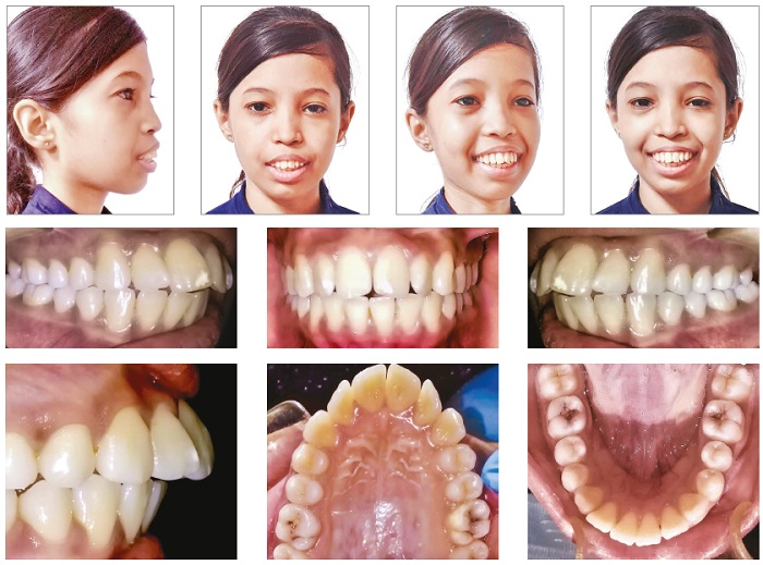 دندانپزشکی بیماران تالاسمی چگونه است