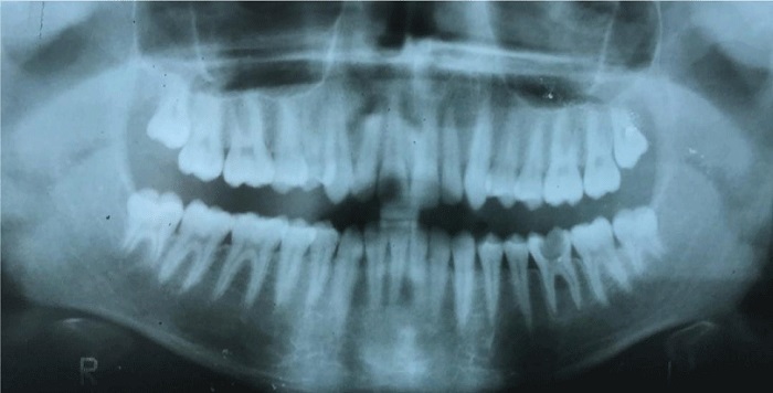 رعایت بهداشت دهان و دندان در بیماران تالاسمی چه مزایایی دارد