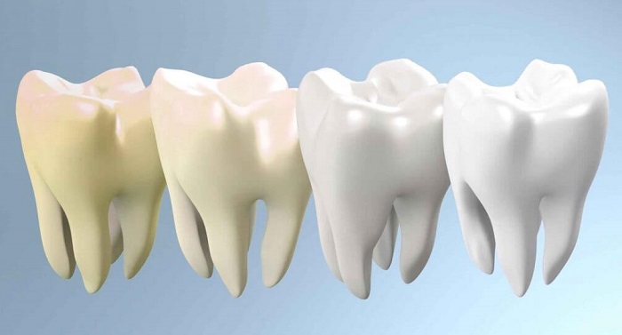 زرد شدن دندان و درمان آن چگونه است