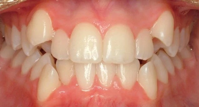 شلوغی دندان ها چه عوارضی دارد