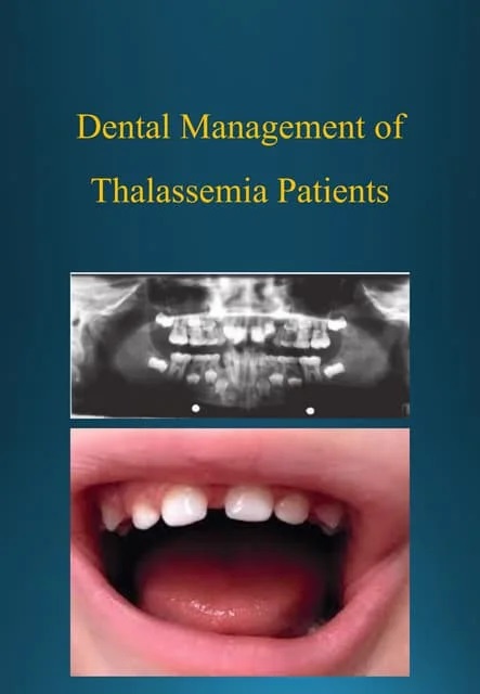 علائم دهان و دندان در بیماران تالاسمی چگونه است