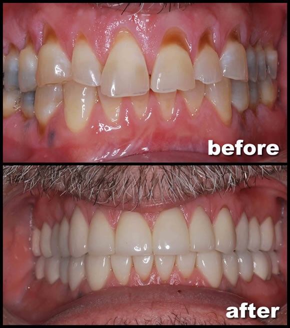 محافظ دندان برای چه بیماری دهان و دندان مناسب است
