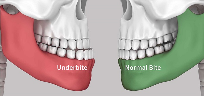 آندربایت دندان چیست و چه علائمی دارد