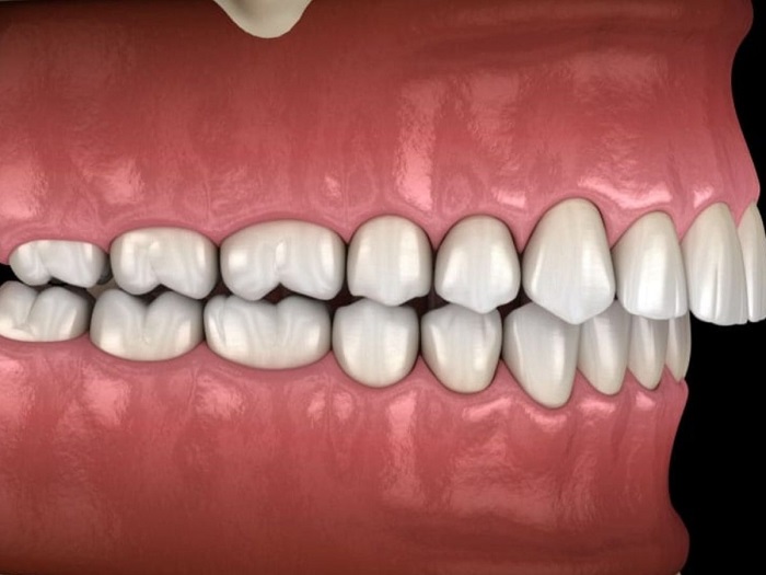 آیا ماملون برای دندان ها عوارض دارند