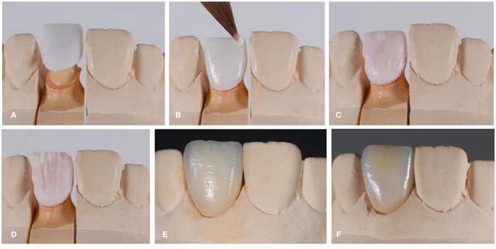 از چه موادی برای بازسازی دندان استفاده میشود