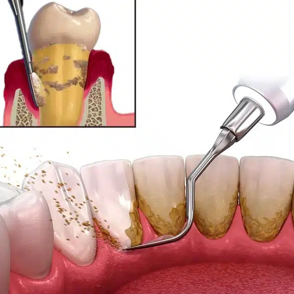 اسکیلینگ دندان چیست و چه کاربردی دارد