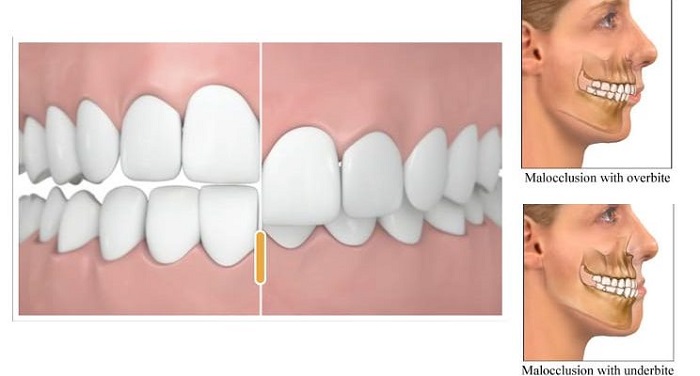 روش های تشخیص آندربایت دندان چگونه است