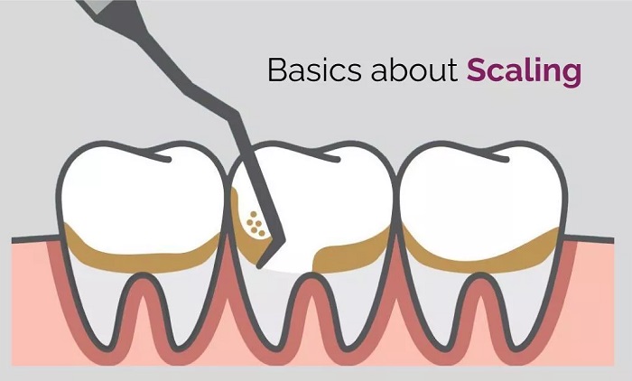 اسکیلینگ دندان از بروز چه بیماریهایی دهان جلوگیری میکند