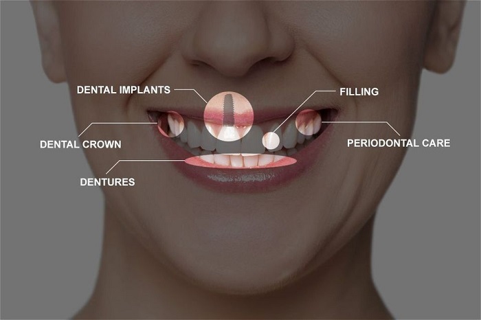 بازسازی کامل دهان چه مزایایی دارد