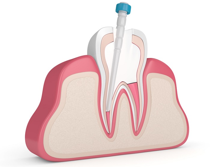 بیلداپ یا بازسازی دندان چیست