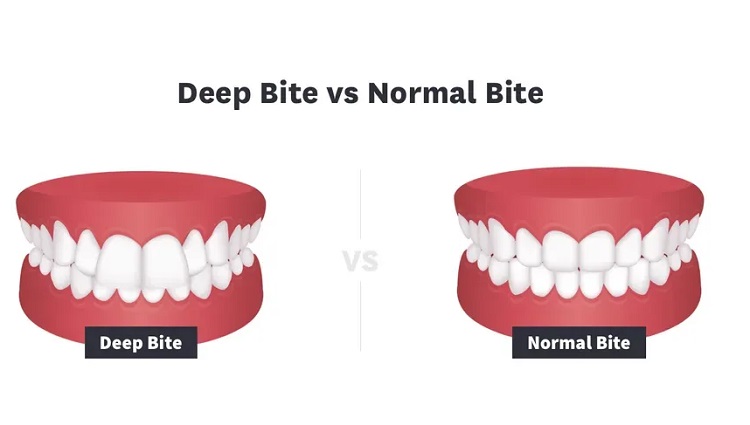 دیپ بایت دندان و علائم آن کدامند