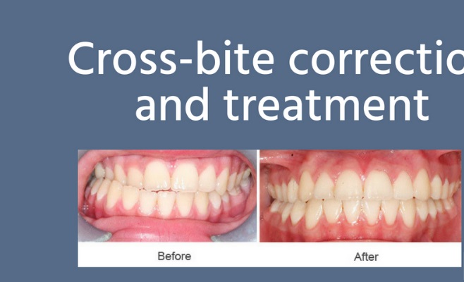 روش های درمان کراس بایت دندان کدامند