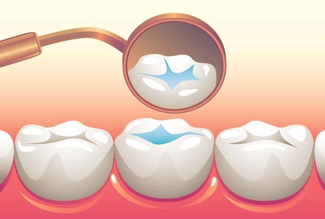 سیلانت دندان چیست و چگونه انجام میشود