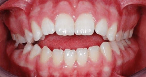 ماملون دندان چیست و چگونه بوجود می آید