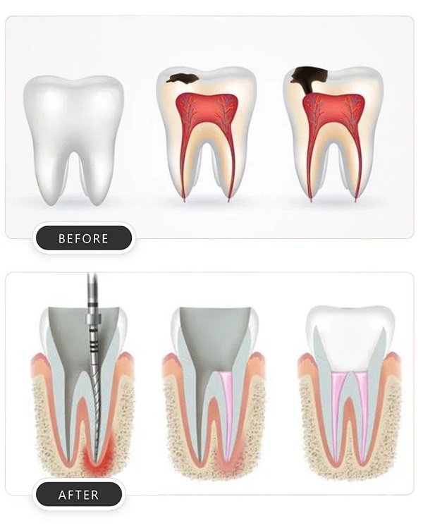 انجام کف بندی دندان دارای چه مراحلی است