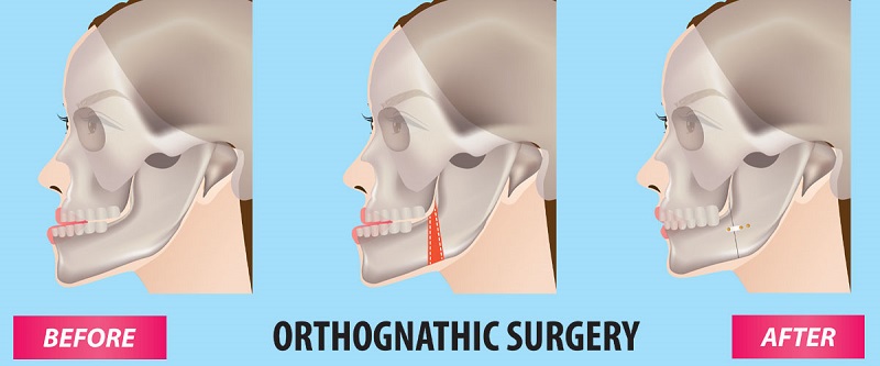 جراحی ارتوگناتیک چه مزایایی دارد