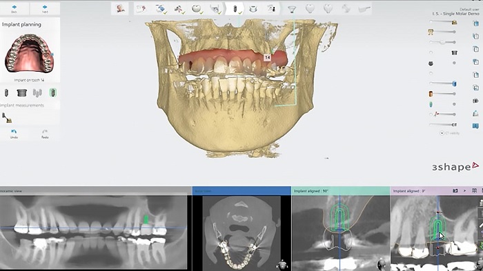 نحوه انجام قالب گیری دیچیتال دندان چگونه است