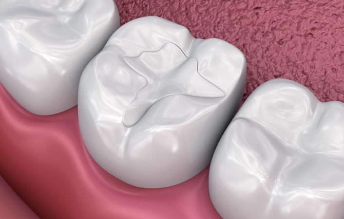 هزینه کف بندی دندان به چه عواملی بستگی دارد