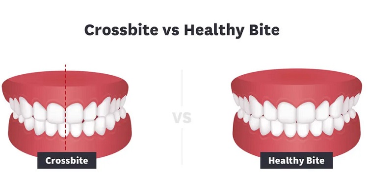 چه دلایلی باعث کراس بایت دندان میشود