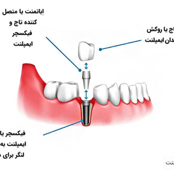 اباتمنت ایمپلنت چیست و چه کاربردی دارد