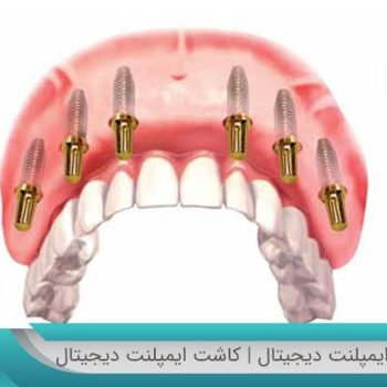 ایمپلنت دندان دیجیتال و چگونه انجام میشود