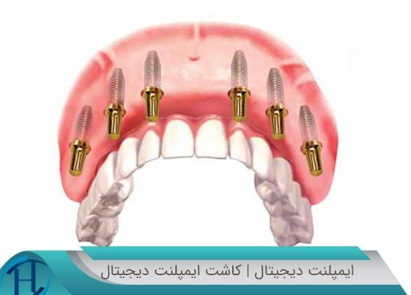 ایمپلنت دندان دیجیتال و چگونه انجام میشود