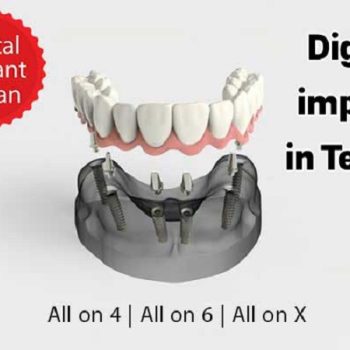 هزینه ایمپلنت دیجیتال در تهران