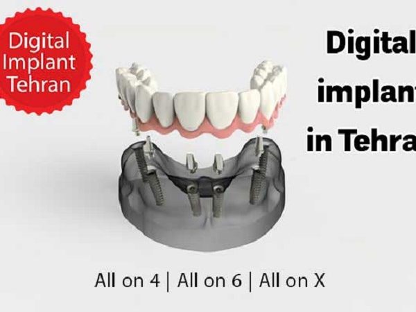 هزینه ایمپلنت دیجیتال در تهران