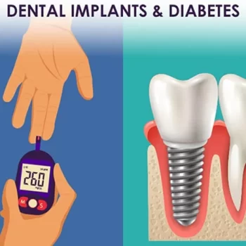 آیا با بیماری دیابت میشود ایمپلنت دندان انجام داد