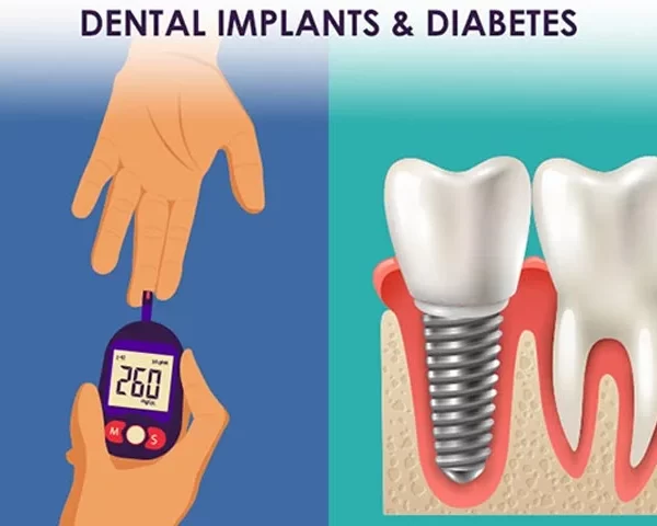 آیا با بیماری دیابت میشود ایمپلنت دندان انجام داد