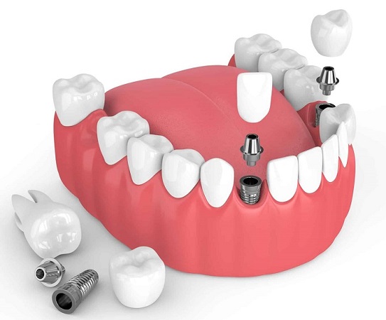 قرار دادن دندان مصنوعی