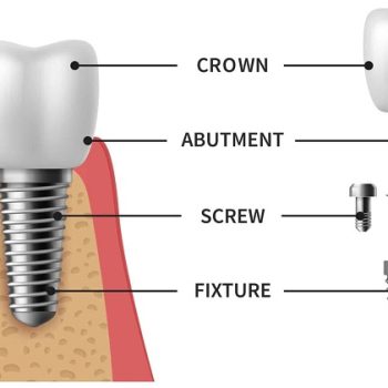 کاشت فیکسچر ایمپلنت چگونه انجام میشود