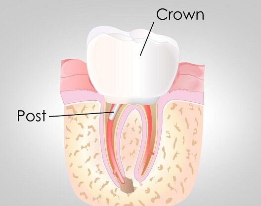 تاج و پست دندان چیست