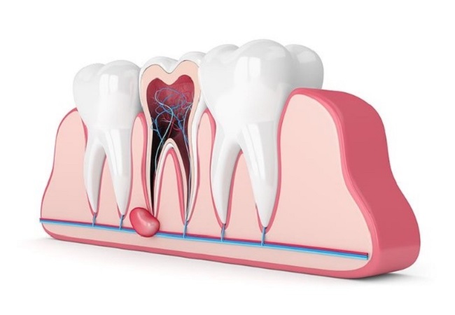 کیست دندان و لثه چه علائمی دارد