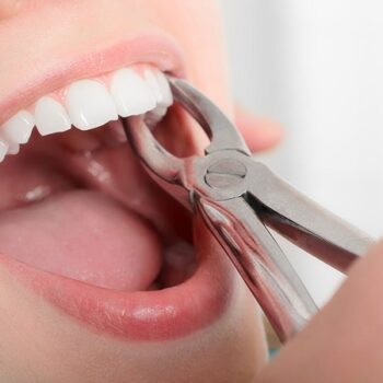 شرایط کشیدن دندان در ارتودنسی