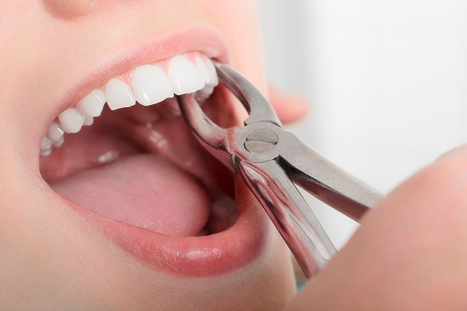 شرایط کشیدن دندان در ارتودنسی