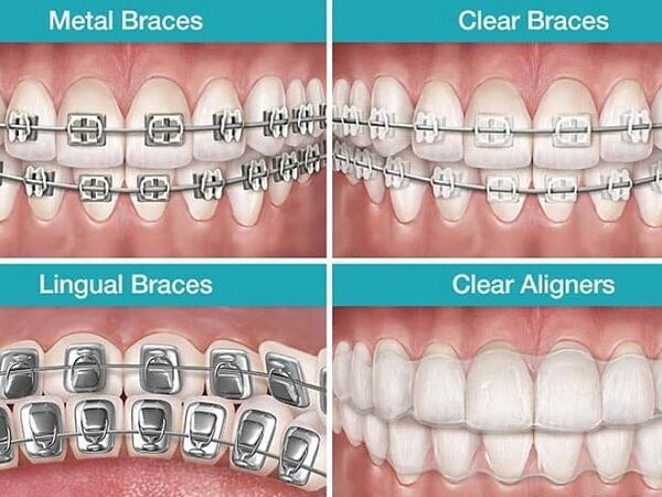 انواع بریس های ارتودنسی کدامند