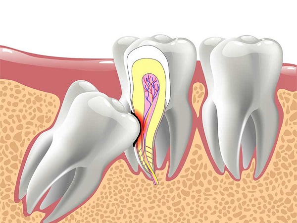 جراحی دندان نهفته چگونه انجام میشود