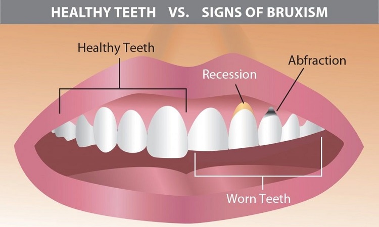 درمان دندان قروچه چگونه است