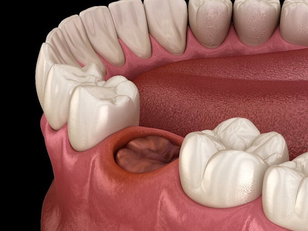حفره خشک دندان چه علائمی دارد