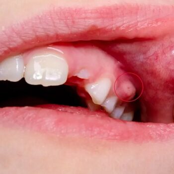آبسه دندان چه علائمی دارد