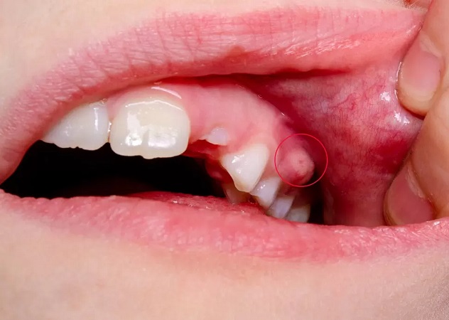 آبسه دندان چه علائمی دارد