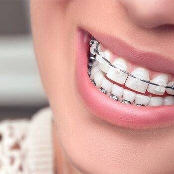 ارتودنسی سرامیکی چه مزایایی برای دهان و دندان دارد
